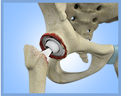 Revision Total Hip Replacement Link - Services