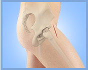 Direct Anterior Total Hip Replacement with Intellijoint - Services
