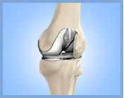 Primary and Revision Total Knee Replacement - Services 