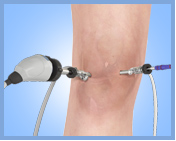 Knee Arthroscopy - Services