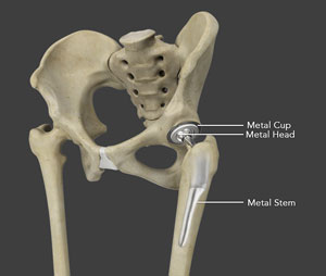 Total Hip Replacement - OrthoInfo - AAOS