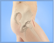 Minimally Invasive Hip Replacement - Direct Anterior Approach Link - Services