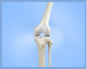 Partial Knee Replacement Link - Services
