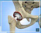 Revision Total Hip Surgery