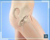 Direct Anterior Total Hip Replacement with intellijoint