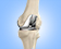 Primary and Revision Total Knee Replacement- Services