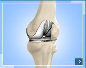 Primary and Revision Total Knee Replacement
