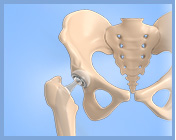 Total Hip Replacement Link - Services